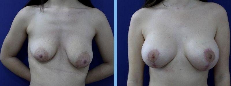 pechos asimetricos antes y después