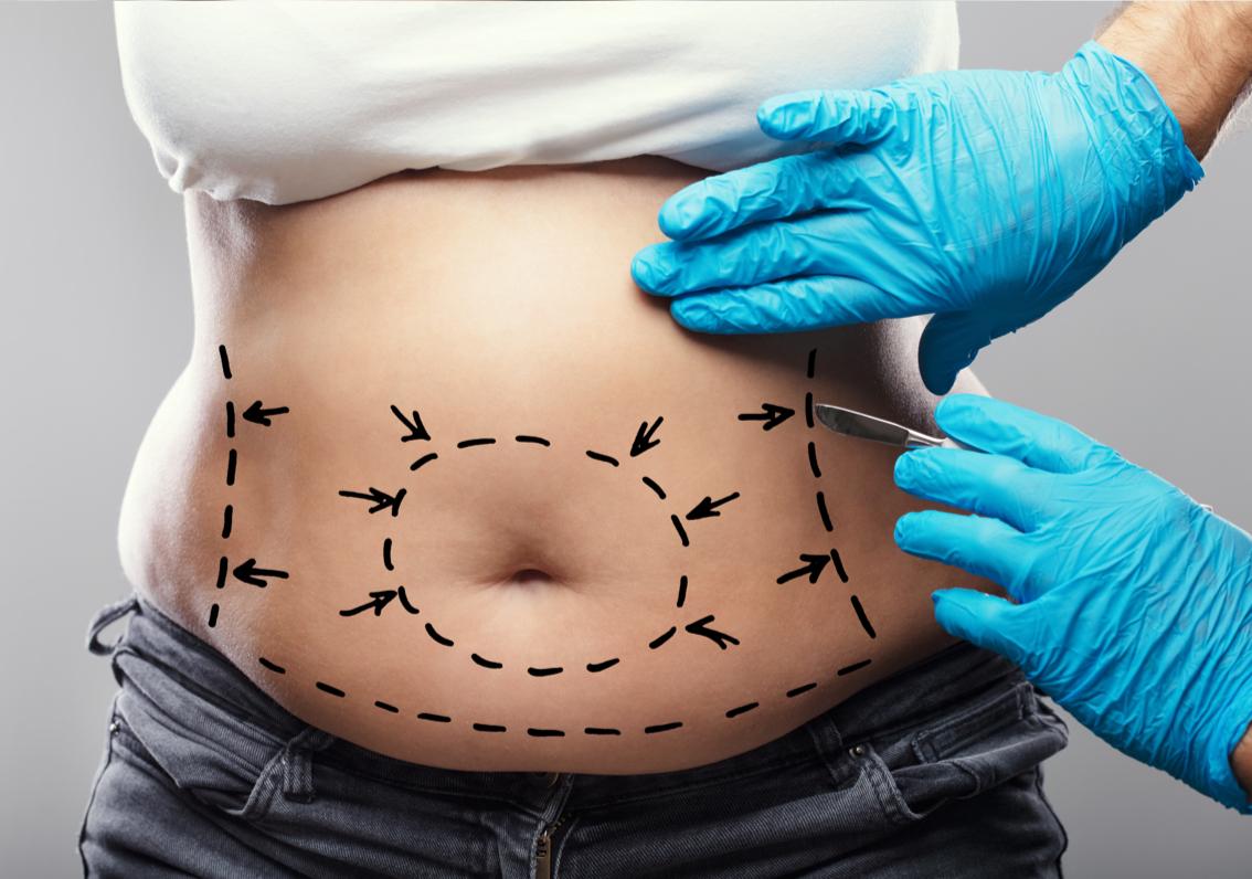 médico haciendo las señales para la operación de la abdominoplastia de una mujer