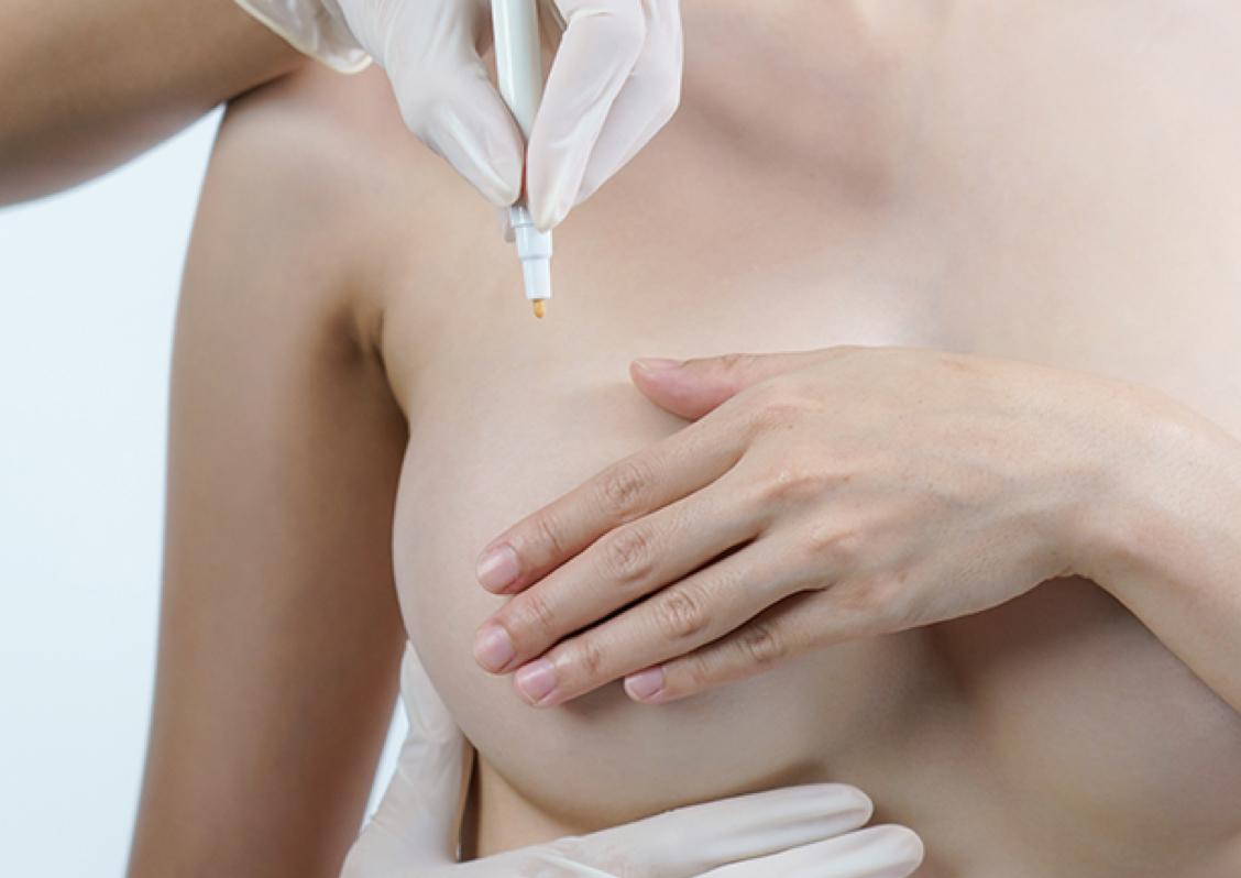 Cirugía de otras anomalias de la mama