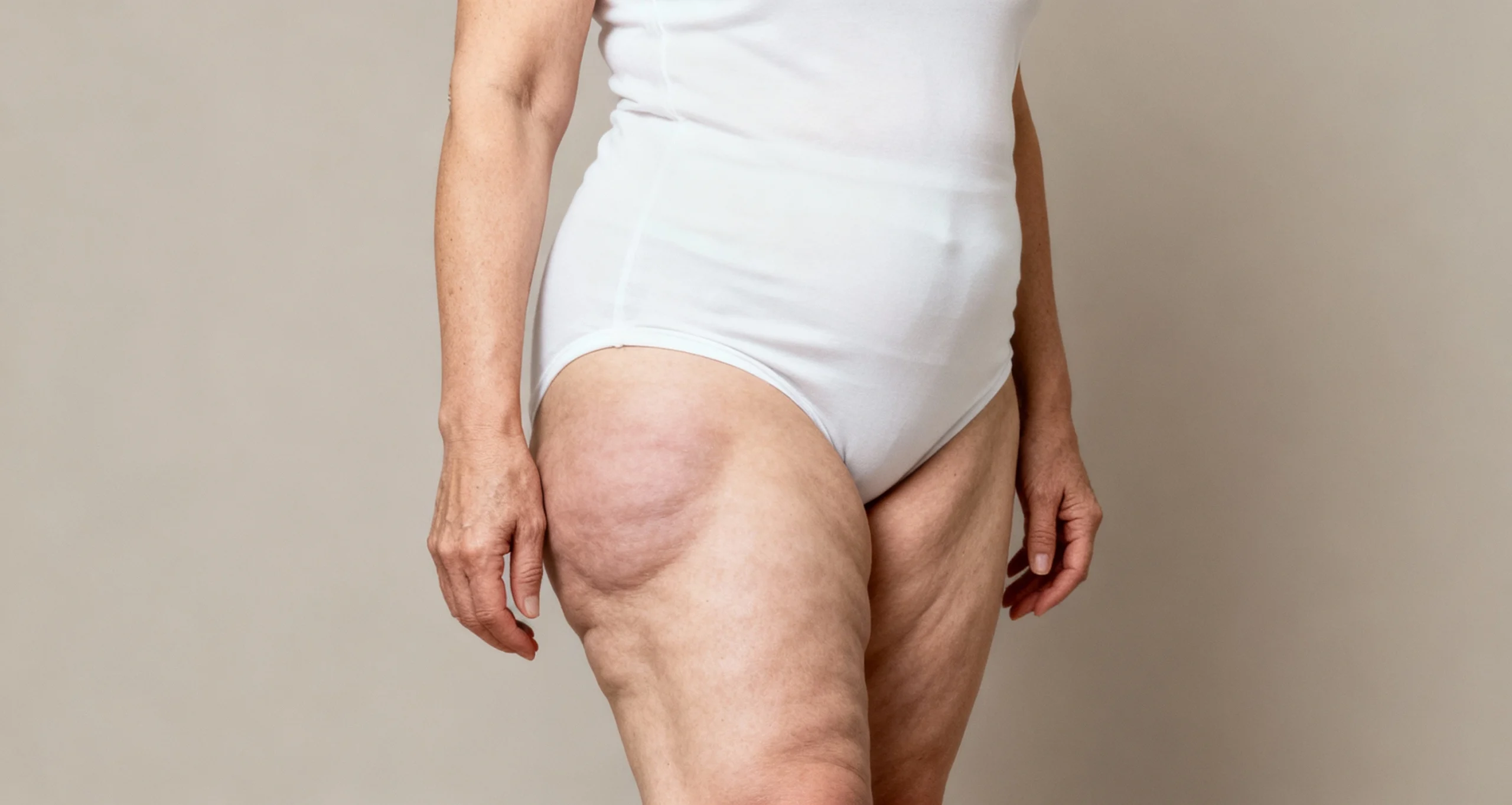 lipedema